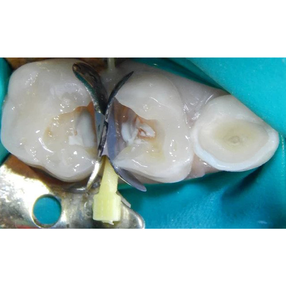 Prevest DenPro CalUltra Calcium Hydroxide Cavity Liner