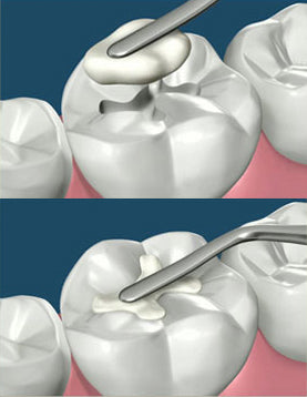 GC Solare Sculpt Universal Restorative Composite