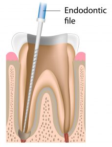 MANI D Finders Endodontic Stainless Steel Files